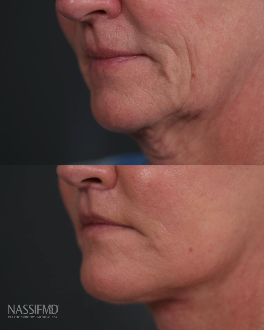 Facelift Before & After Gallery - Patient 150920 - Image 1