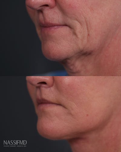Facelift Before & After Gallery - Patient 150920 - Image 1