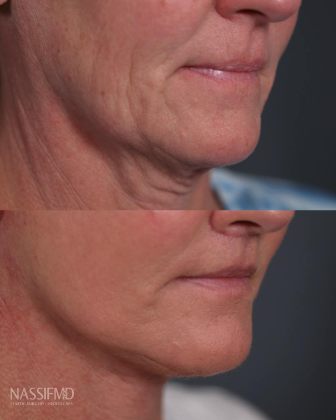 Facelift Before & After Gallery - Patient 150920 - Image 2