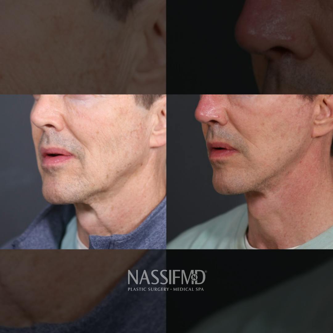 Facelift Before & After Gallery - Patient 158199 - Image 1
