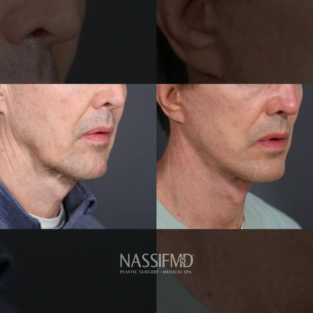 Facelift Before & After Gallery - Patient 158199 - Image 2