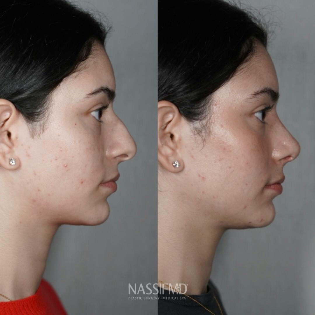 Primary Rhinoplasty Before & After Gallery - Patient 389381 - Image 1