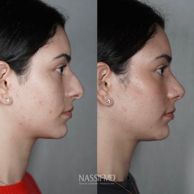 Primary Rhinoplasty Before & After Gallery - Patient 389381 - Image 1