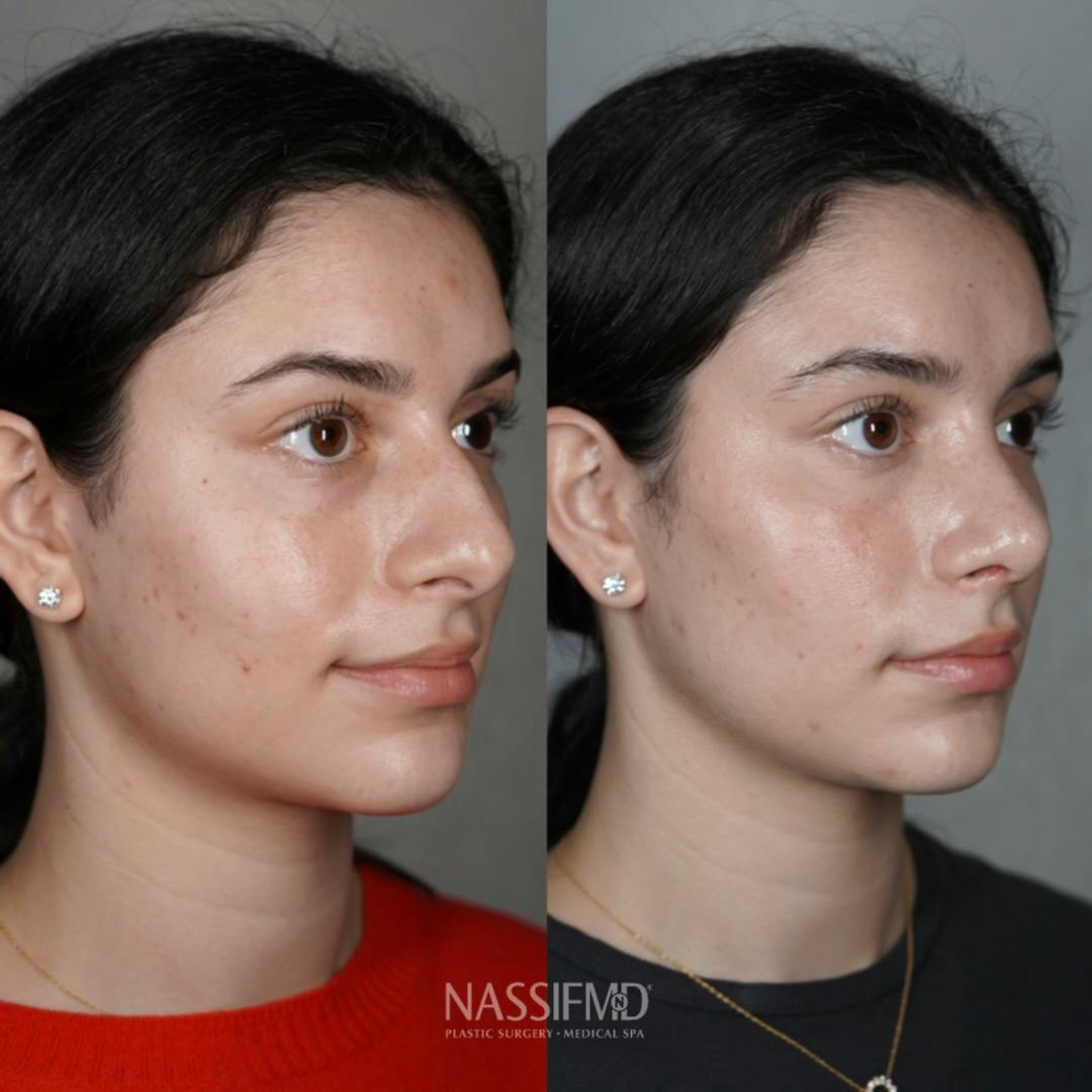 Primary Rhinoplasty Before & After Gallery - Patient 389381 - Image 2