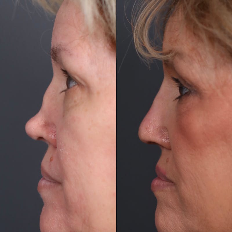 Revision Rhinoplasty Before & After Gallery - Patient 181138 - Image 2