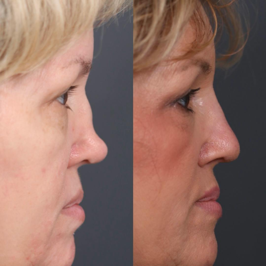 Revision Rhinoplasty Before & After Gallery - Patient 181138 - Image 1