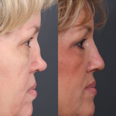 Revision Rhinoplasty Before & After Gallery - Patient 181138 - Image 1