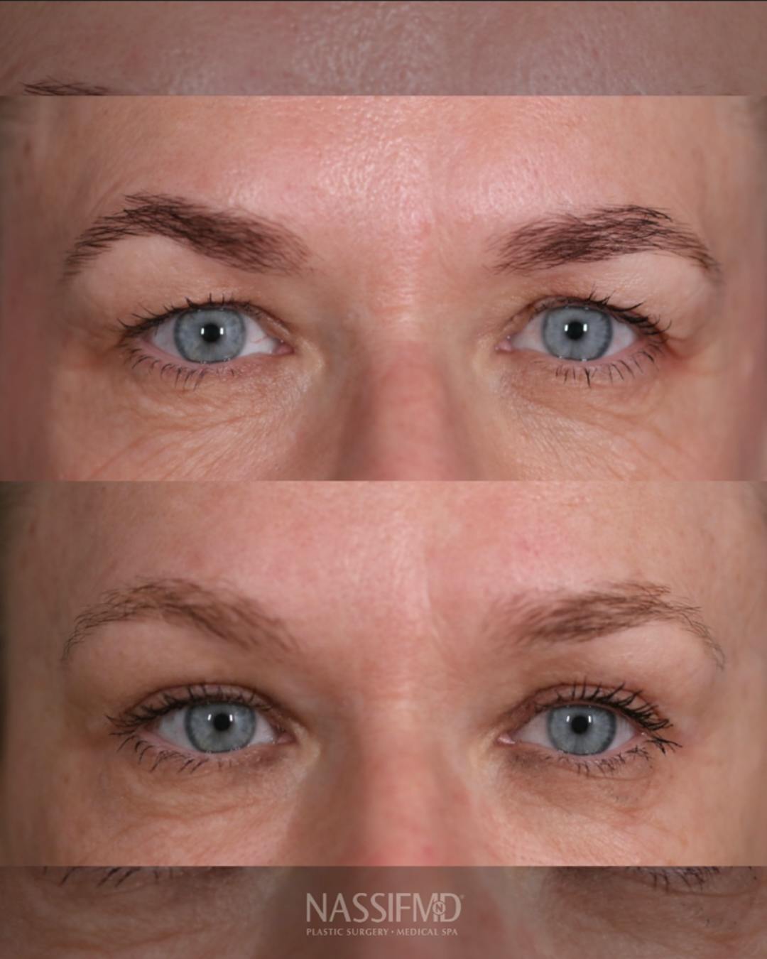 Upper Blepharoplasty Before & After Gallery - Patient 375648 - Image 2