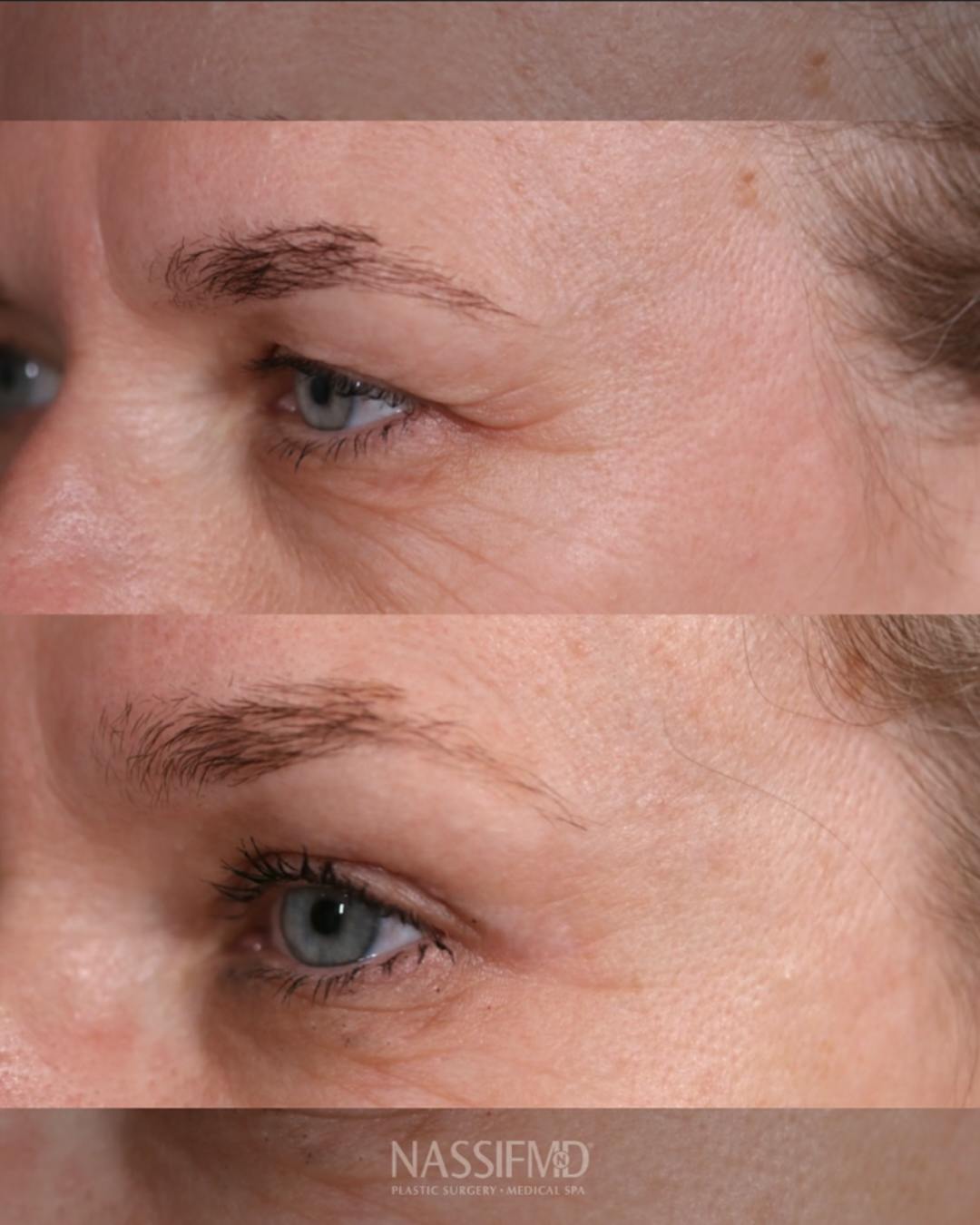 Upper Blepharoplasty Before & After Gallery - Patient 375648 - Image 1