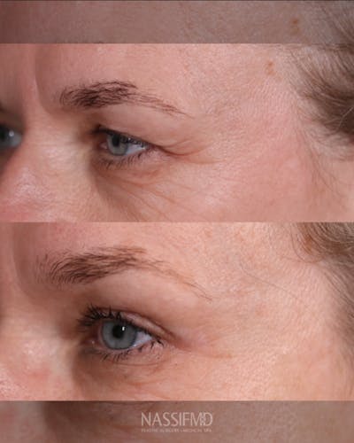 Upper Blepharoplasty Before & After Gallery - Patient 375648 - Image 1
