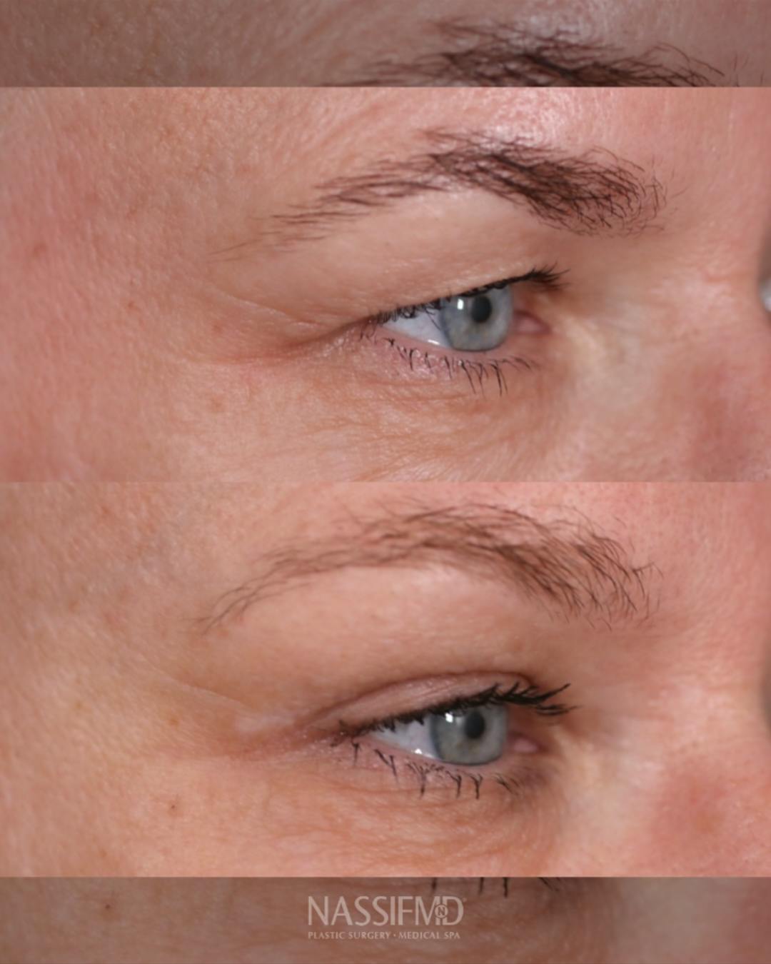 Upper Blepharoplasty Before & After Gallery - Patient 375648 - Image 3