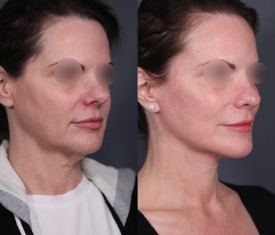 Facelift Before & After Gallery - Patient 344583 - Image 1