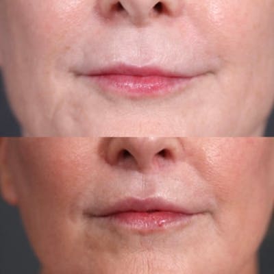 Lip Lift Before & After Gallery - Patient 315606 - Image 1