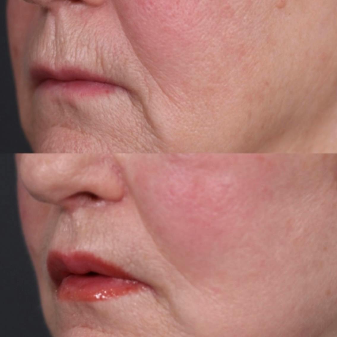 Lip Lift Before & After Gallery - Patient 403270 - Image 1