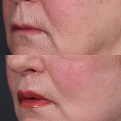 Lip Lift Before & After Gallery - Patient 403270 - Image 1