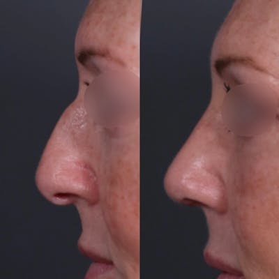 Revision Rhinoplasty Before & After Gallery - Patient 172193 - Image 1