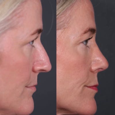 Revision Rhinoplasty Before & After Gallery - Patient 520723 - Image 1
