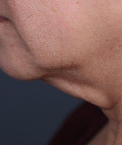 Neck Lift Before & After Gallery - Patient 108420700 - Image 1