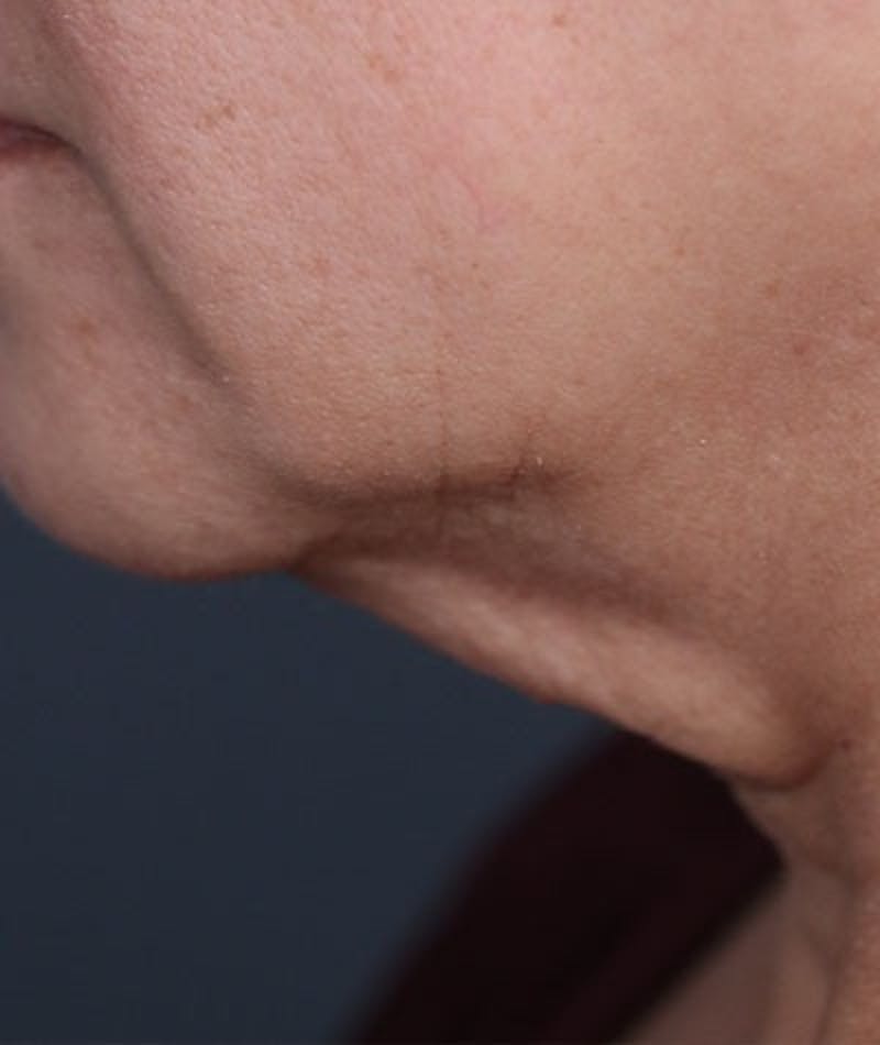 Neck Lift Before & After Gallery - Patient 108420700 - Image 1