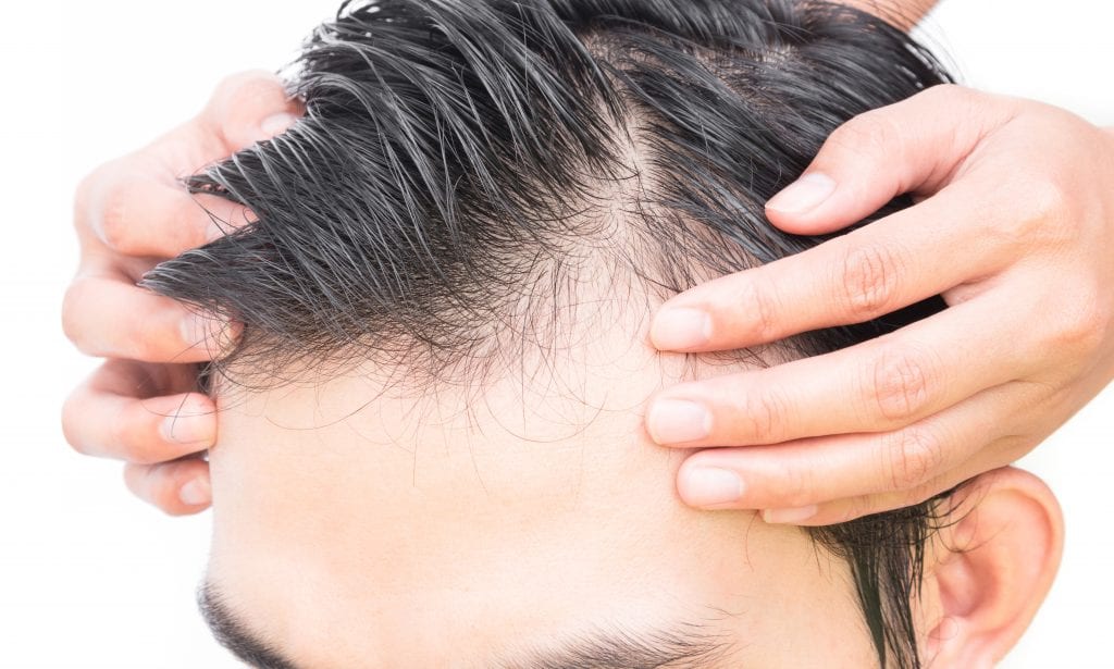 Japanese researchers may have found cure for baldness hair loss