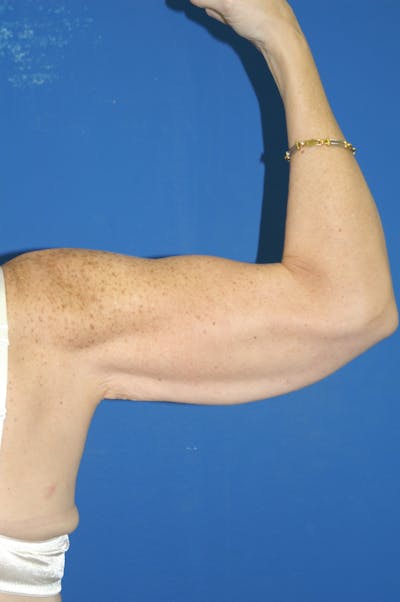 Arm Lift Before & After Gallery - Patient 115390857 - Image 1