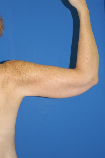 Arm Lift Before & After Gallery - Patient 115390857 - Image 2