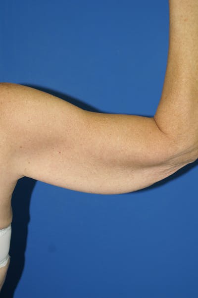 Arm Lift Before & After Gallery - Patient 115390912 - Image 1