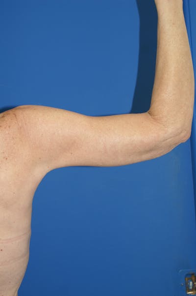 Arm Lift Before & After Gallery - Patient 115390912 - Image 2