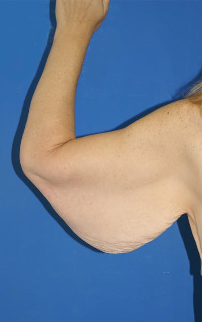 Arm Lift Before & After Gallery - Patient 115390924 - Image 1
