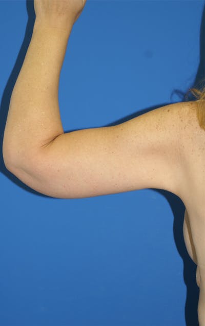 Arm Lift Before & After Gallery - Patient 115390924 - Image 2
