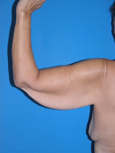 Arm Lift Before & After Gallery - Patient 115390928 - Image 1