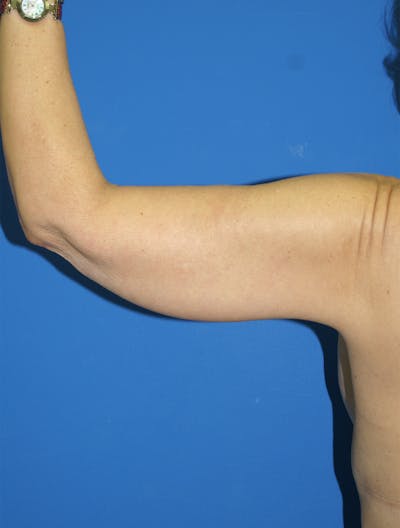 Arm Lift Before & After Gallery - Patient 115390928 - Image 2