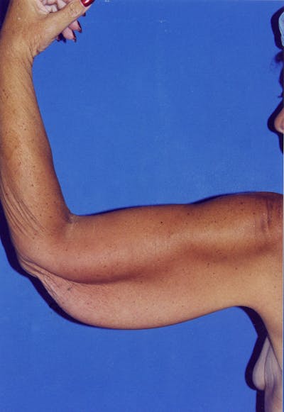 Arm Lift Before & After Gallery - Patient 115390929 - Image 1