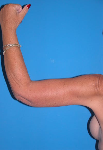 Arm Lift Before & After Gallery - Patient 115390929 - Image 2
