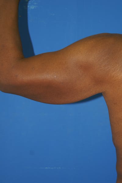 Arm Lift Before & After Gallery - Patient 115390935 - Image 1