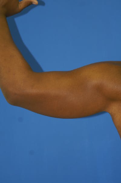 Arm Lift Before & After Gallery - Patient 115390935 - Image 2