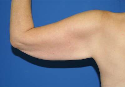 Arm Lift Before & After Gallery - Patient 115390937 - Image 1