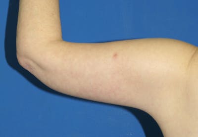 Arm Lift Before & After Gallery - Patient 115390937 - Image 2