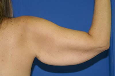 Arm Lift Before & After Gallery - Patient 115390939 - Image 1
