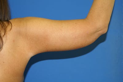 Arm Lift Before & After Gallery - Patient 115390939 - Image 2