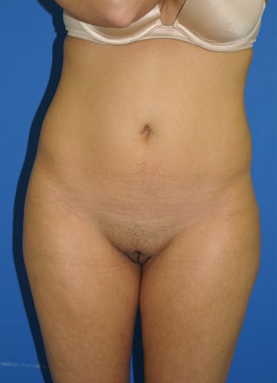 Liposuction Before & After Gallery - Patient 115391113 - Image 1