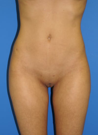 Liposuction Before & After Gallery - Patient 115391113 - Image 2