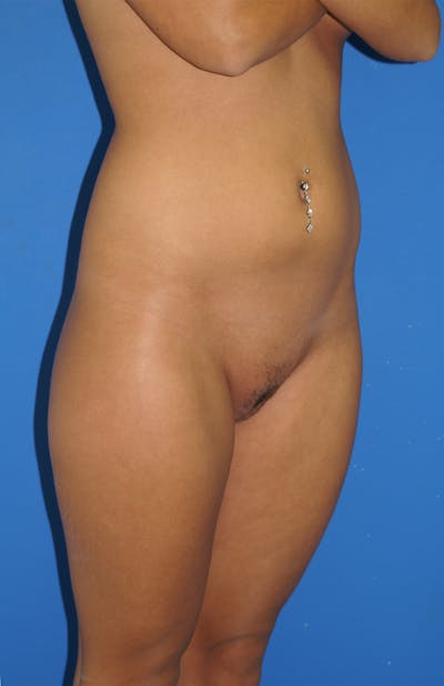 Liposuction Before & After Gallery - Patient 115391199 - Image 1