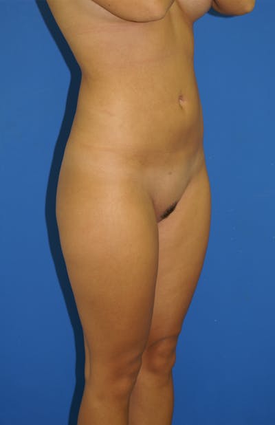 Liposuction Before & After Gallery - Patient 115391199 - Image 2