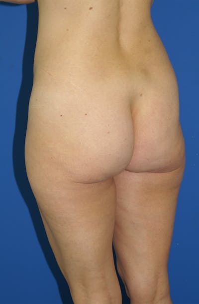 Liposuction Before & After Gallery - Patient 115391247 - Image 1