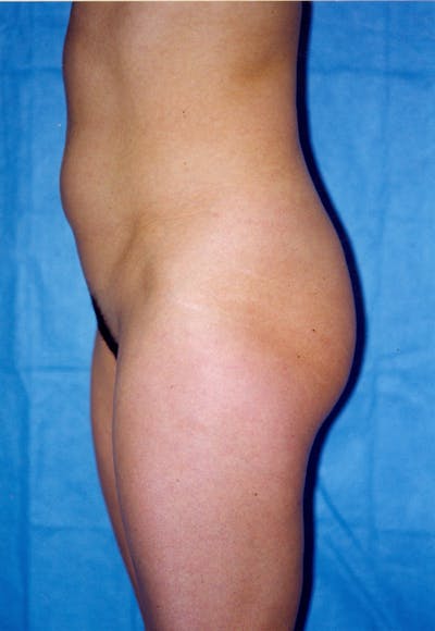 Liposuction Before & After Gallery - Patient 115391357 - Image 1
