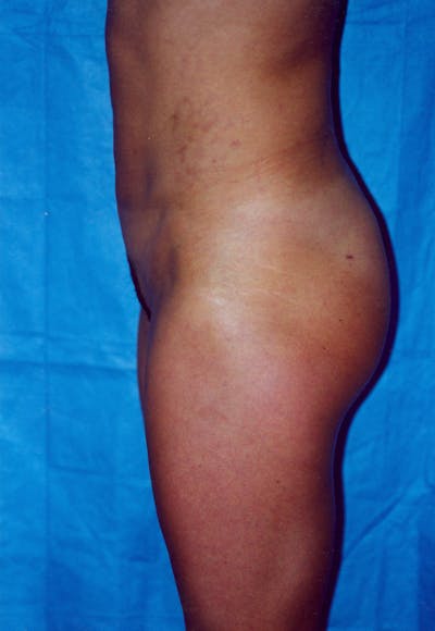 Liposuction Before & After Gallery - Patient 115391357 - Image 2