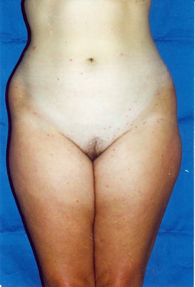Liposuction Before & After Gallery - Patient 115391370 - Image 1