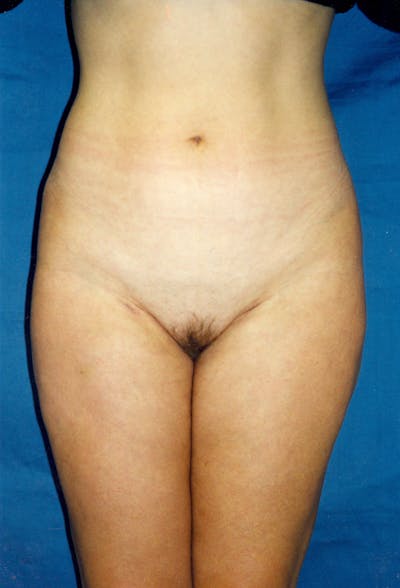 Liposuction Before & After Gallery - Patient 115391370 - Image 2