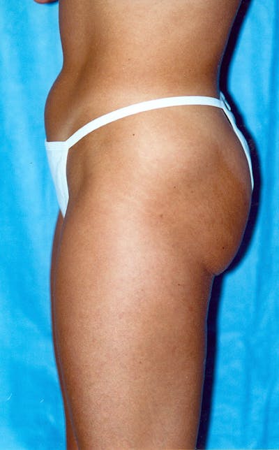 Liposuction Before & After Gallery - Patient 115391373 - Image 1
